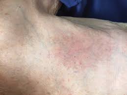 The skin of the breast might also seem puckered, such as the skin of an orange. Radiation Recall Dermatitis Triggered By Prednisone Mdedge Dermatology