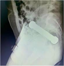 Dummy shoves 4-pound dumbbell in anus, needs emergency surgery