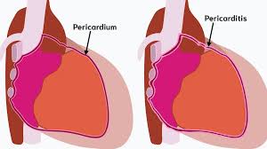 Image result for Pericarditis