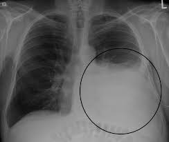 Lawyers often help prove claims in which asbestos exposure can be traced to a specific product or place. Mesotelioma Un Tipo De Tumor De Pleura