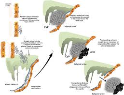 Image result for Calcium Nephrolithiasis
