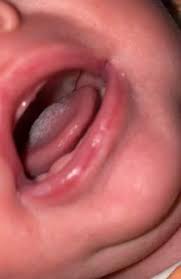Ist Es Wieder Soor Baby