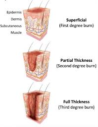 Classification Of Burn Injury Depth Burns Treatment Second Degree Burn Treatment Burns