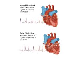 Image result for Atrial Fibrillation