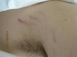 However, it's important to know that all acne lesions can scar. I Have Developed Strange Horizontal Scar Like Marks On My Inner Thighs What Is The Cause Of This Quora