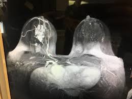 The lung cancer detection is the extension of the image processing that produces the results of feature extraction and feature selection after segmentation. Screening Mri Detects Bi Rads 3 Breast Cancer In High Risk Patients Imaging Technology News