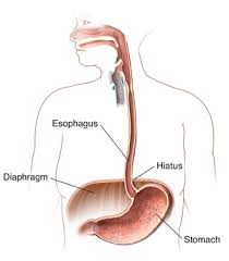 Image result for stomach hernia symptoms
