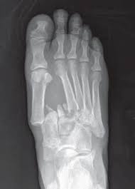 These range from subtle ligamentous sprains, often seen in athletes, to fracture dislocations seen in. Ap Radiograph Showing A Divergent Type Lisfranc Injury As Classifi Ed Download Scientific Diagram