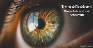 Trabekulektomi Goz Tansiyonu Ameliyati Nedir Nasil Yapilir Glokom Goz Gozameliyati Glokomameliyati Goztansiyonu Saglik Tansiyon Gozler Dusuk Gozler