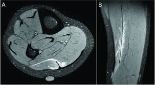 There is mild marrow stress response within the 4th metatarsal proximally. Connective Tissue Injury In Calf Muscle Tears And Return To Play Mri Correlation British Journal Of Sports Medicine