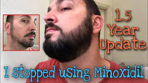 In general, minoxidil should be used for four to six months before deciding its effectiveness. there you have. I Stopped Using Minoxidil On My Beard And 1 5 Year Update 18 Months Youtube