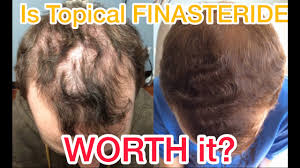 Treatment programs can take 3 to 6 months of daily use to start. Amazing Results From Topical Finasteride For Hair Loss And Thinning Hair Youtube