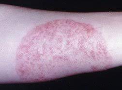 The topical cream at 1% is very weak and does not work well. Ringworm Tinea Guide Causes Symptoms And Treatment Options
