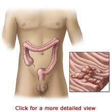 If you notice blood in the toilet bowl or on toilet paper after wiping, it could be an early sign of colon cancer, but this symptom is also a common symptom of conditions such as crohn's disease, hemorrhoids, ulcers, or ulcerative colitis. Colon Cancer Patient Education Colonial Healthcare