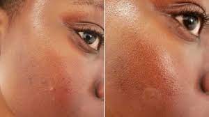 I've reordered the mighty patch hydrocolloid stickers four times already since initially trying them out because they work so well at absorbing pus and fluids from pimples and unexpected breakouts. I Reviewed The Mighty Patch Amazon S Most Popular Acne Patches Revelist