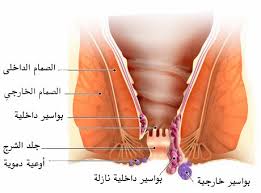 طرق علاج البواسير الداخلية والخارجية للمرأة والرجل موقع عرب زوم