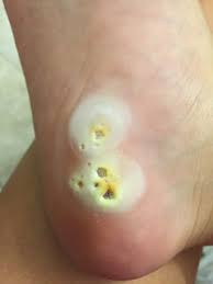 Check spelling or type a new query. How To Remove Plantar Warts Naturally Artsea Chic