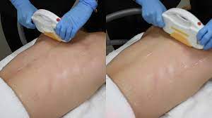 They're not all the same, so be sure to read the label. The Global Beauty Group 3 Business Benefits Ipl Vs Shr Male Hair Removal Youtube