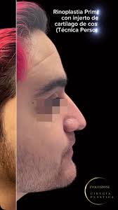 Rinoplastia Primaria con injerto de cartílago de costilla (técnica  personal), Primary rhinoplasty with rib cartilage graft (personal technique)