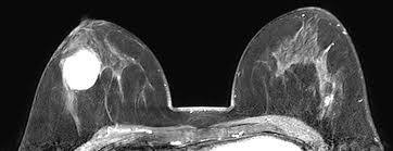 Zweifel Bei Scheinbar Gutartigem Brusttumor Swiss Medical Forum