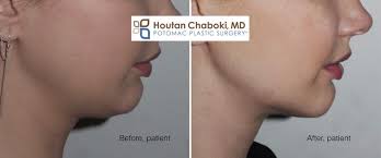 Because there are several different approaches, double chin surgery varies in cost, from $1,200 to $12,700, according to the american board of cosmetic surgery. Chin Liposuction To Improve A Double Chin