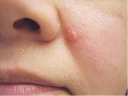 Image result for skin cancer on nose pimple