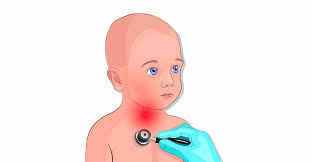 Image result for Croup