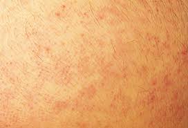 Most lumps are harmless but it's important to see your gp if you're worried or the be the size of a pea or a golf ball. Pictures Of Bumps On Skin Cysts Skin Tags Lumps And More