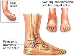 ankle sprain active care physiotherapy clinic