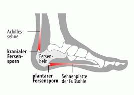 Haglund Syndrom Wikipedia