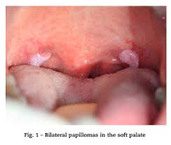 Image result for papillomavirus tongue)