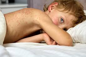 Image result for Measles