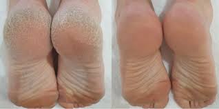 Image result for Anhidrosis