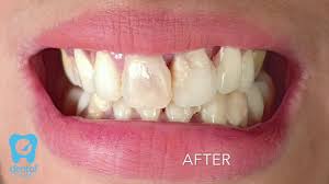 We did not find results for: Gigi Tiruan Lepasan Bahan Thermosens Rekomendasi Terbaik Youtube