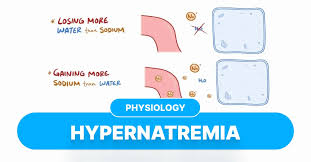 Image result for Hypernatremia