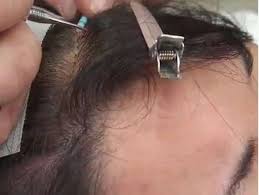 Female Hair Replacement And Hair Loss Solutions For Women Surehair International