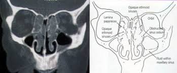 Large polyps may cause difficulty breathing, infections, and an altered sense of smell. Functional Endoscopic Sinus Surgery American Family Physician