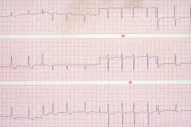 Fibrillation auriculaire temporaire ou permanente. Un Registre Sur L Ablation Dans La Fibrillation Auriculaire En Europe Le Quotidien Du Medecin