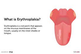 Image result for Erythroplakia roof of mouth