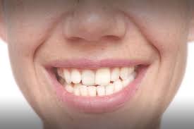 Can mewing fix crooked teeth? How To Fix Crooked Teeth Kansas City Mo Matthew A Turner Dds Pc