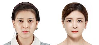 No.1 Plastic Surgery attracting foreign patients l JK Plastic Surgery