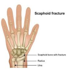 Image result for Scaphoid Fracture Signs
