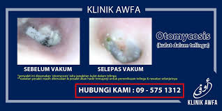 Obat sakit telinga perlu anda ketahui sebagai langkah pertolongan awal. Dr Ahmed Klinik Awfa On Twitter Jangkitan Kulat Dalam Telinga Ikuti Bebenang Ini Sehingga Akhir Seorang Pesakit Datang Ke Klinik Awfa Katanya Ada Telinga Tak Dengar Gatal Telinga Malam Malam Keluar