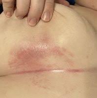 Dry out the skin fold and treat the skin infection causing the rash. Intertrigo Altmeyers Encyclopedia Department Dermatology