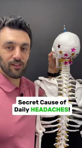 #headaches #headacherelief #thoracicmobility #migraine #migrainerelief…