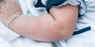 Image result for Hives