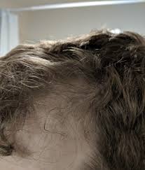 Syphilis has symptomatic and asymptomatic stages. 26 Year Old Unsure About My Hair Loss Alopecia And Hair Disorders Forums Patient