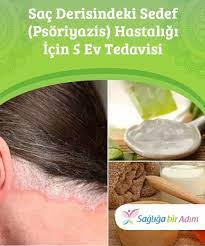 Sac Derisindeki Sedef Psoriyazis Hastaligi Icin 5 Ev Tedavisi Bu Kronik Bir Hastalik Olmasina Ragmen Sac Derisindeki Sedef Hastaligini Iyilestirmemi Remedies