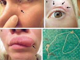 A Mosquito Bite A Parasitic Worm A Nightmarish Scenario Goats And Soda Npr