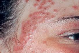 Image result for Eczema
